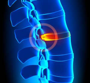 spinal cord injury